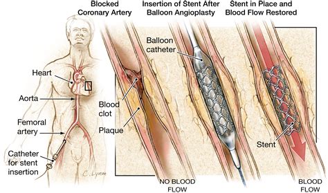 Pain or numbness in your legs, hands, or feet. . How to check heart blockage without angiography